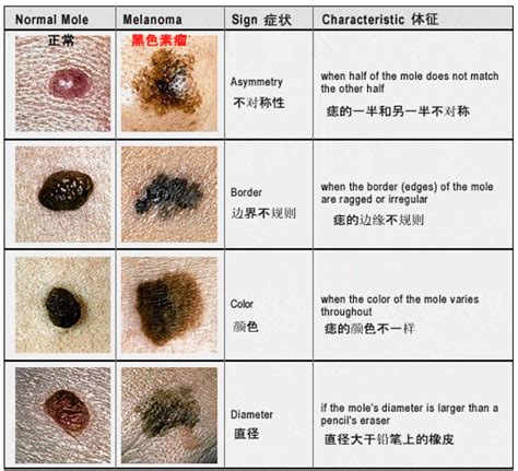 痦子|哪种「痣」需要小心！